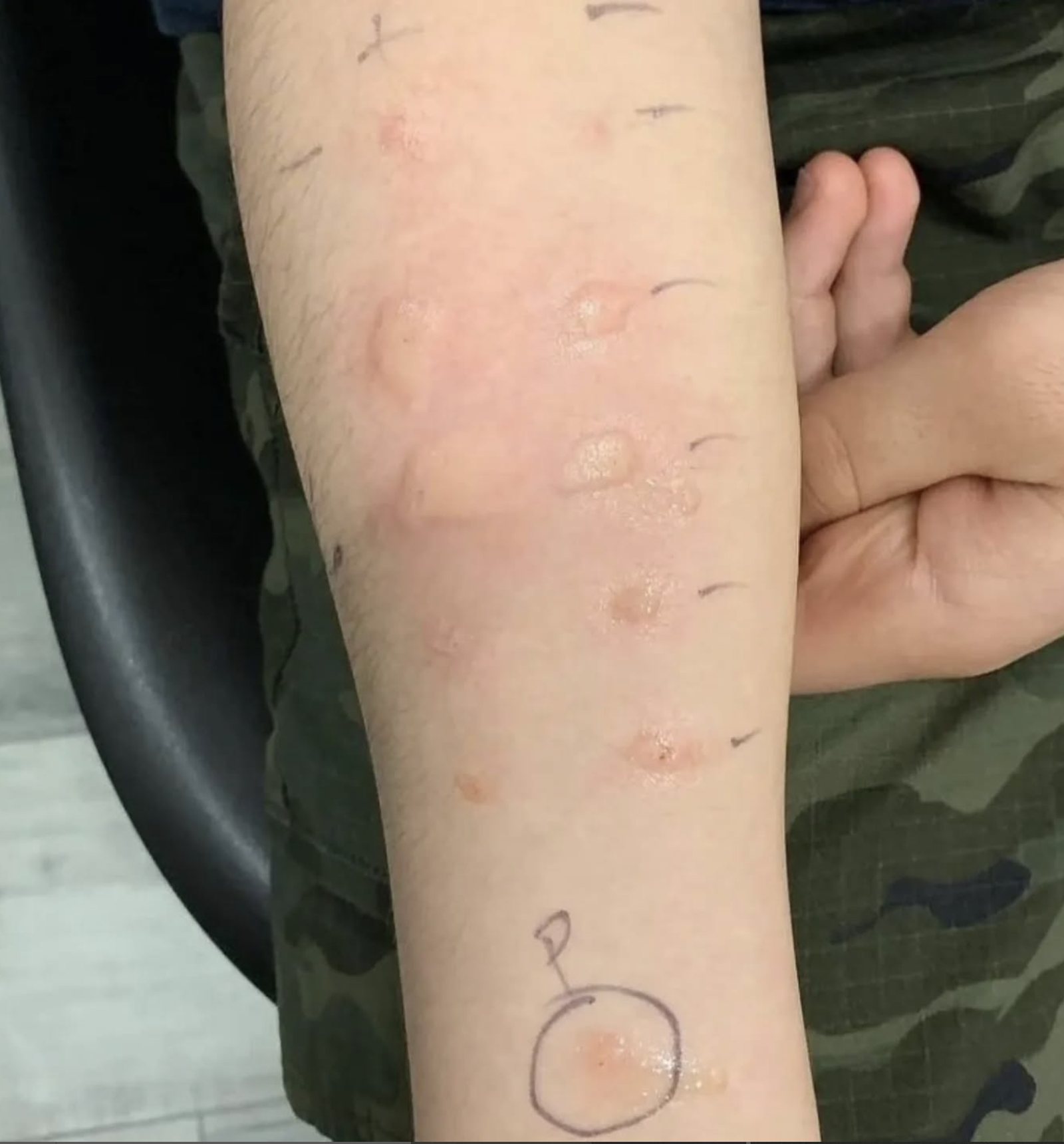 Featured image for the article Peanut Allergy